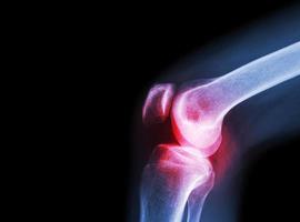 Film x-ray knee joint with arthritis photo