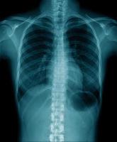 chest x-ray show inside of lung photo