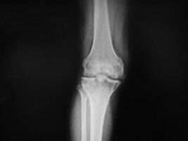 Black and white X-ray film of the knee and leg. photo